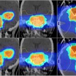Helium ion radiotherapy proven to be safer for pediatric cancer treatment Helium ion radiotherapy proven to be safer for pediatric cancer treatment