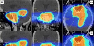 Helium ion radiotherapy proven to be safer for pediatric cancer treatment Helium ion radiotherapy proven to be safer for pediatric cancer treatment