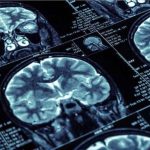 Poverty’s Lasting Effects on the Brain Poverty's Lasting Effects on the Brain