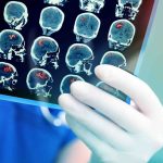 Breakthrough in stroke treatment which will save lives Breakthrough in stroke treatment which will save lives