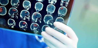 Breakthrough in stroke treatment which will save lives Breakthrough in stroke treatment which will save lives