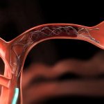 Endovascular therapy for stroke sufferers Endovascular therapy for stroke sufferers