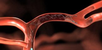 Endovascular therapy for stroke sufferers Endovascular therapy for stroke sufferers