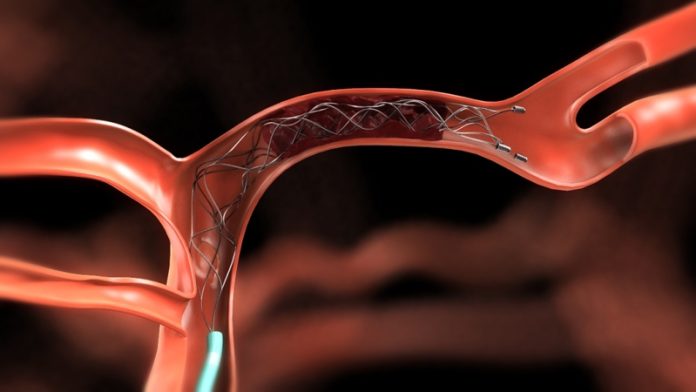 Endovascular therapy for stroke sufferers