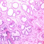 Researchers kill prostate cancer cells with copper Researchers kill prostate cancer cells with copper