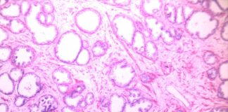 Researchers kill prostate cancer cells with copper Researchers kill prostate cancer cells with copper