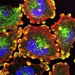 Triple whammy therapy combats deadly melanomas Triple whammy therapy combats deadly melanomas