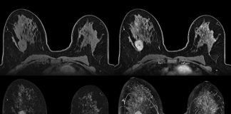 Higher rate of breast cancer detected with MRI Higher rate of breast cancer detected with MRI