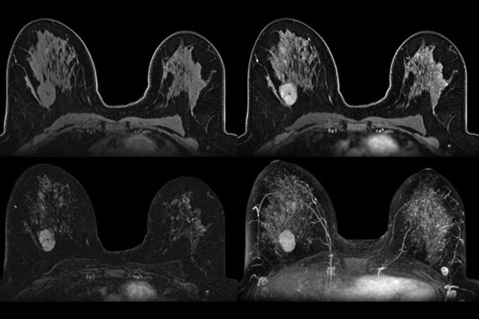 Higher rate of breast cancer detected with MRI