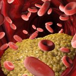 Intestinal bugs not cholesterol may cause heart attacks and strokes Intestinal bugs not cholesterol may cause heart attacks and strokes