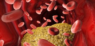 Intestinal bugs not cholesterol may cause heart attacks and strokes Intestinal bugs not cholesterol may cause heart attacks and strokes