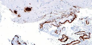 Ultrasound shown to be a possible cure for Alzheimer’s disease Ultrasound shown to be a possible cure for Alzheimer’s disease