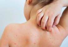 UK Health Experts Advocate Universal Chickenpox Vaccination for All Children, Urging NHS Action UK Health Experts Advocate Universal Chickenpox Vaccination for All Children, Urging NHS Action
