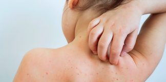 UK Health Experts Advocate Universal Chickenpox Vaccination for All Children, Urging NHS Action UK Health Experts Advocate Universal Chickenpox Vaccination for All Children, Urging NHS Action