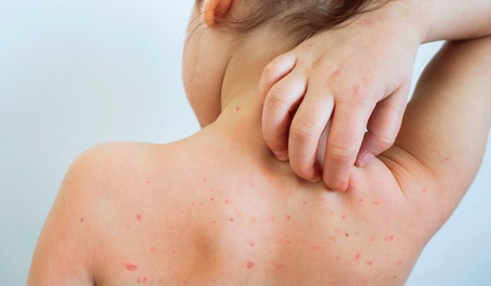 UK Health Experts Advocate Universal Chickenpox Vaccination for All Children, Urging NHS Action